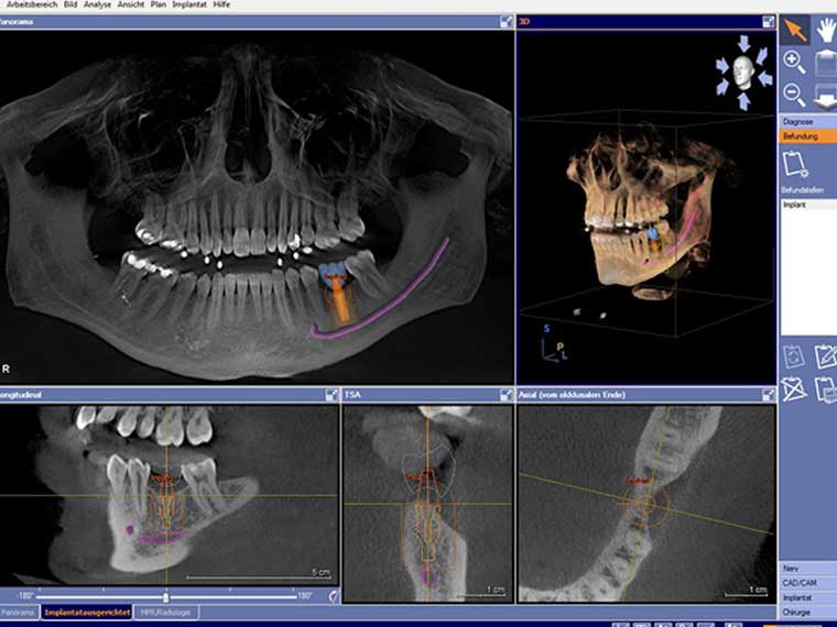 Implantologie Röntgenbild