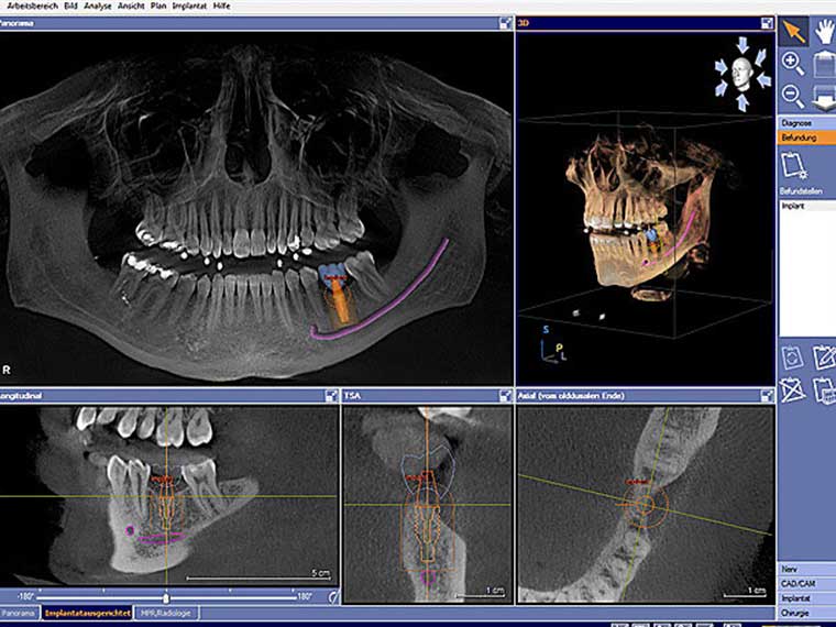 3D Röntgen DVT (Digitales Volumen-Tomogramm)