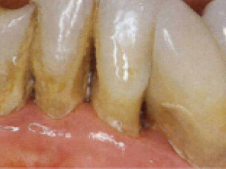 Entzündetes Zahnbett (Parodontitis)